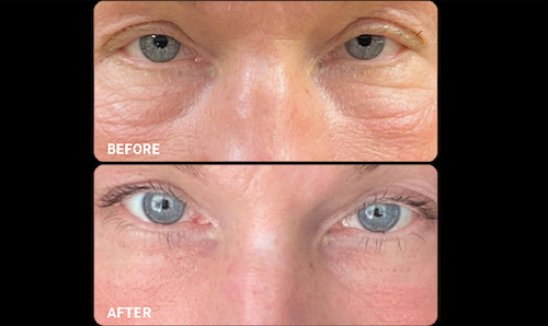 Under Eye Filler Before After Dark Circles Mississauga Oakville